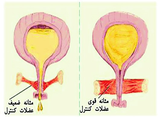 افتادگي مثانه